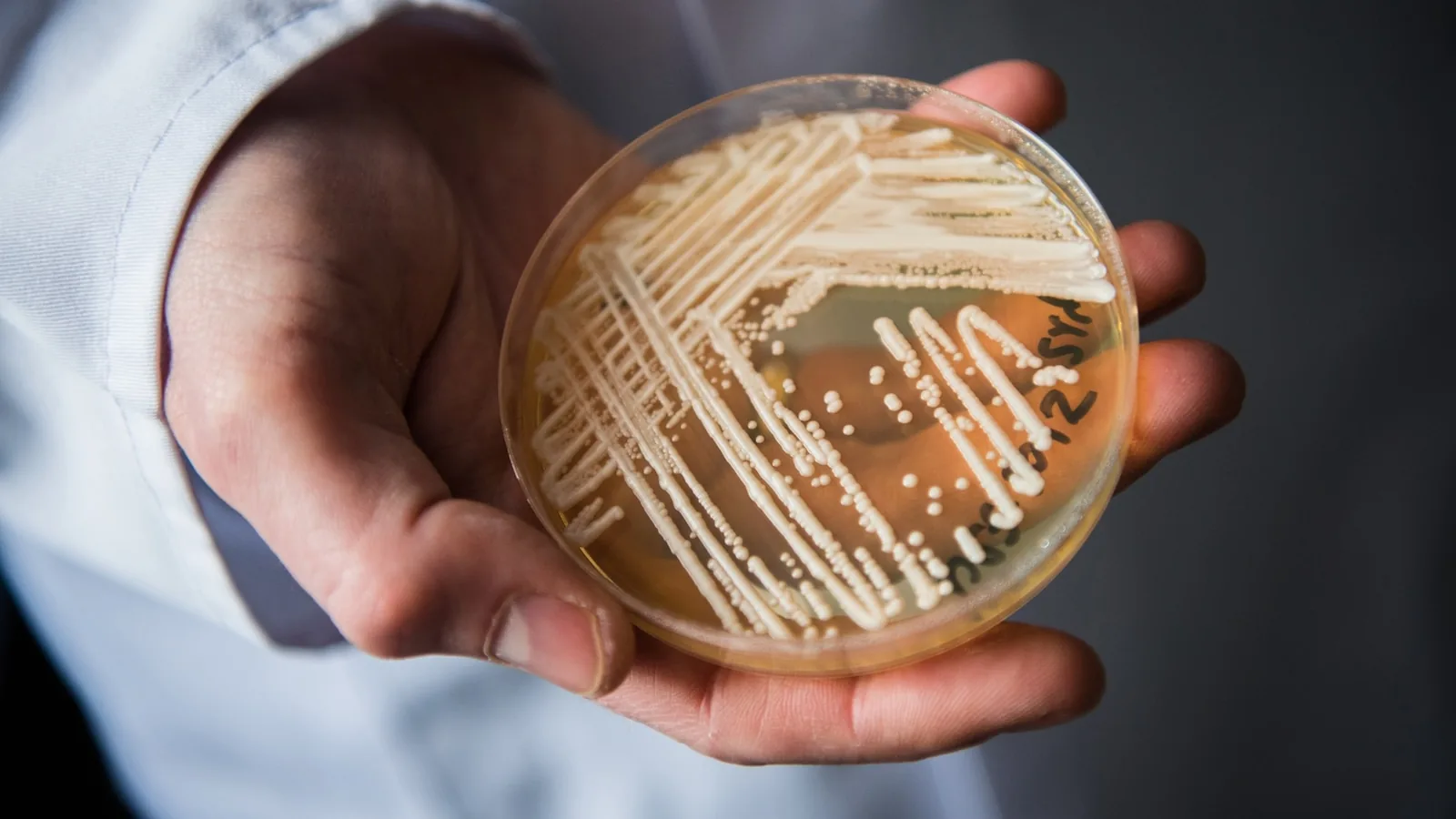 Laboratory sample vial and hospital corridor representing CDC tracking of Candida auris cases